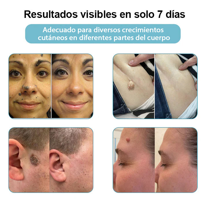 Lápiz láser no invasivo para la eliminación de lunares y verrugas Ｎatravor™