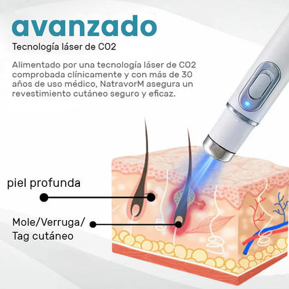 Lápiz láser no invasivo para la eliminación de lunares y verrugas Ｎatravor™